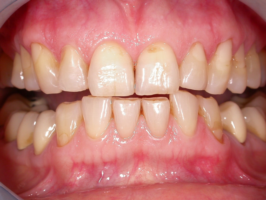 Abradierte, gelbliche Zähne mit vielen Kunststoff-Füllungen und Kronen, die der Patientin nicht gefallen haben